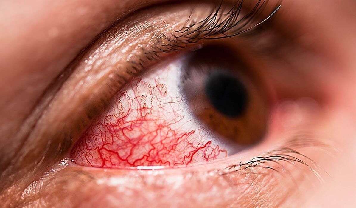 La retinopatía diabética es una de las complicaciones tardías de la diabetes